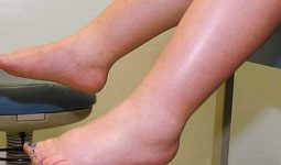 Phù chân ở người cao tuổi có đáng ngại?