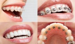Tìm hiểu “quy trình niềng răng như thế nào”