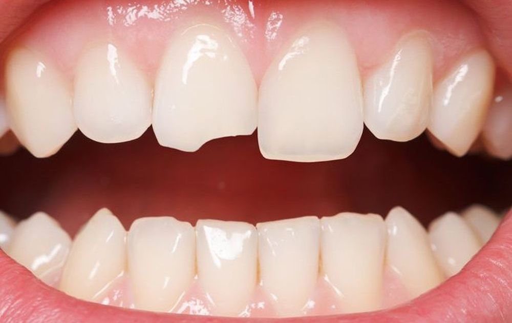 Răng sứ bị mẻ | Nguyên nhân và cách khắc phục kịp thời