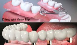 Nên làm răng giả tháo lắp hay cố định khi mất răng vĩnh viễn?
