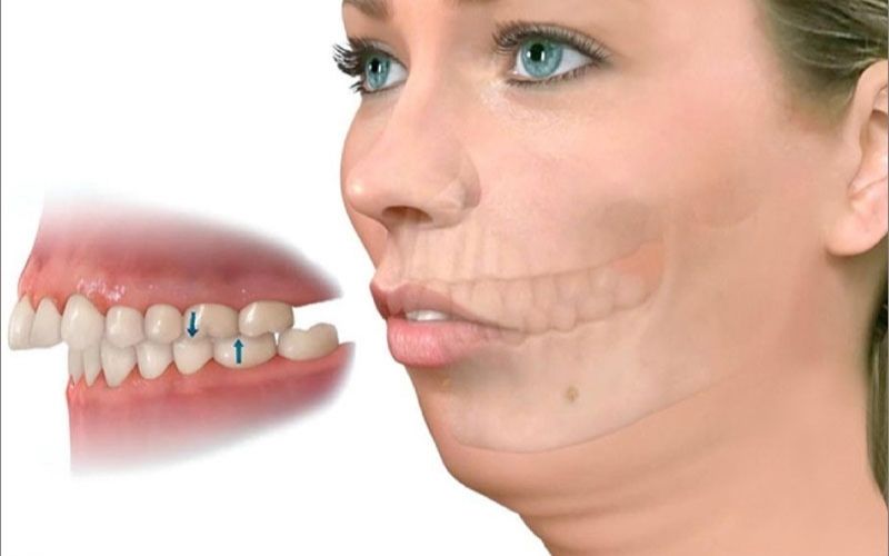 Tình trạng răng hàm hô