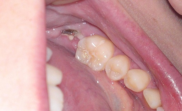 Răng hàm sâu bị vỡ có nguy hiểm không? - Nha Khoa Quốc Tế Việt Đức