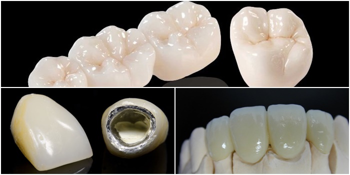 Răng sứ titan có mấy loại? Bọc răng sứ Titan uy tín tại Nha khoa Kim