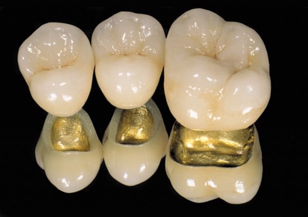 Răng sứ kim loại quý là gì? – Nha Khoa Nhân Tâm