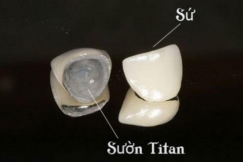 Răng sứ titan có tốt không?