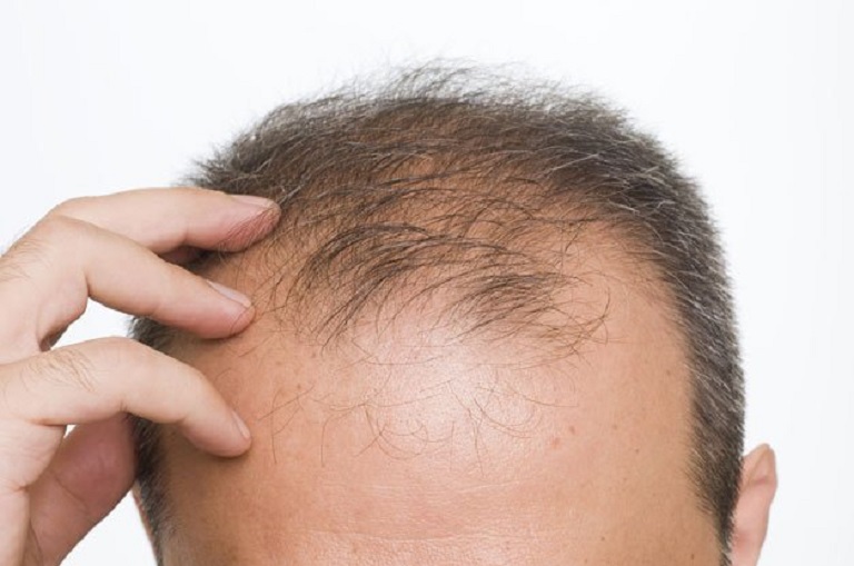 Thiếu hụt testosterone là một trong những nguyên nhân chính gây rụng tóc ở nam giới