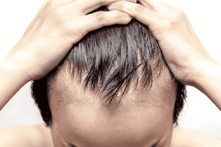 Dihydrotestosterone làm tăng tuyến nhờn gây nên tình trạng tóc bết ở nam giới