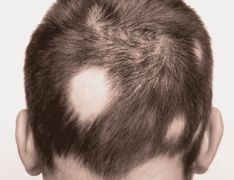 Rụng tóc do nội tiết tố nam tạo ra những mảng hói gây tự ti cho nam giới