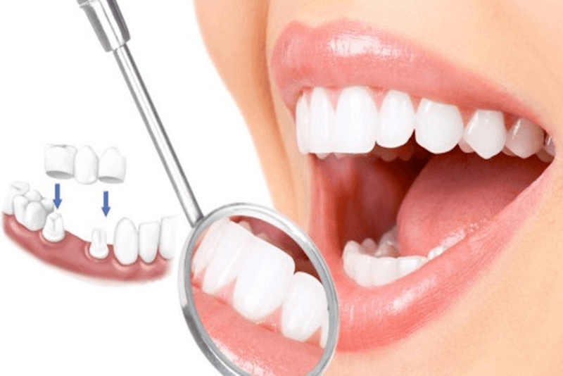 Bọc răng sứ là lựa chọn thẩm mỹ nha khoa hàng đầu hiện nay