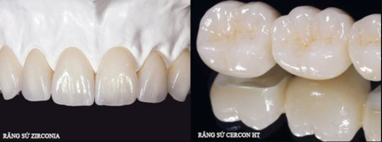 So sánh răng sứ zirconia và cercon - Nha Khoa Tâm Sài Gòn