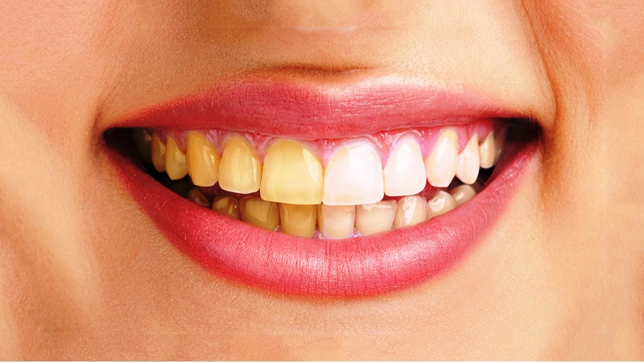 Răng Bị Ố Vàng Có Nên Bọc Răng Sứ? – Nha Khoa Quốc Tế Á Châu
