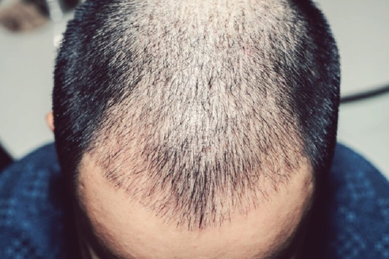 Rụng tóc ở nam giới Cách điều trị rụng tóc ở nam giới