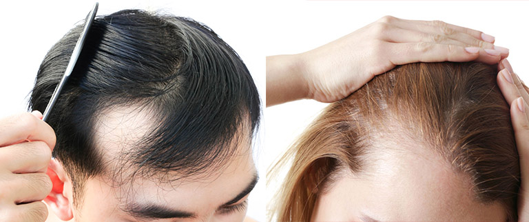 Nhổ tóc ngứa xoăn có thể gây hói đầu
