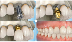Trồng răng hàm trên bằng Implant giá bao nhiêu tiền rẻ nhất?