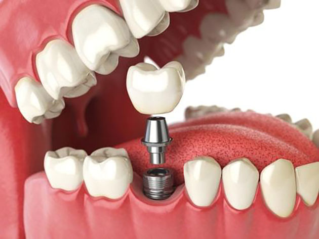 Trồng răng dùng trụ là Implant
