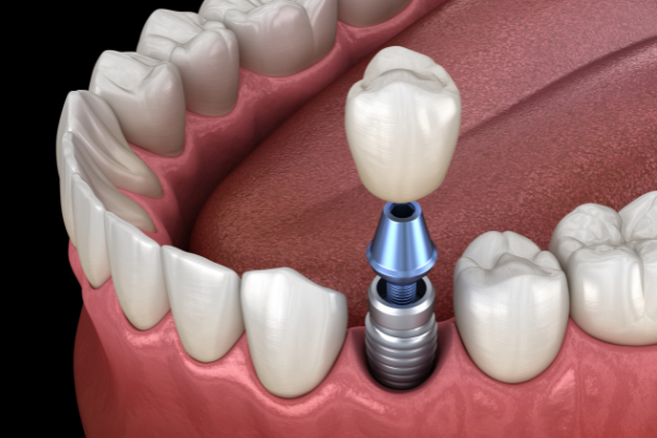 trồng răng implant là giải pháp phục hình răng bị mất lâu năm được nhiều người lựa chọn