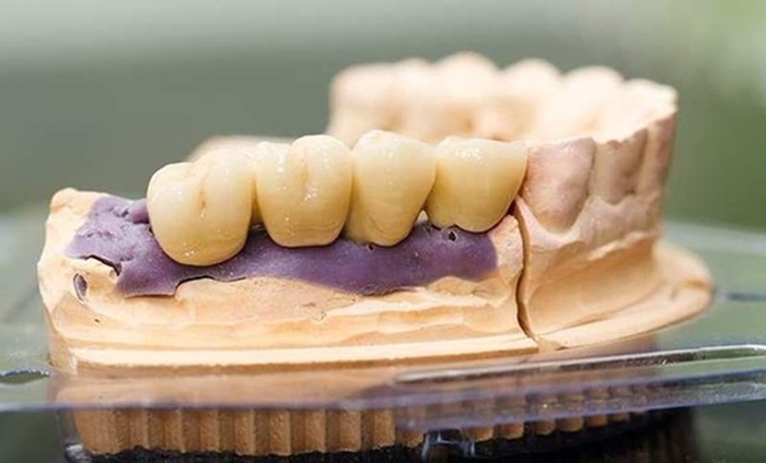 Trồng răng sứ Titan có tốt không | Chia sẻ từ chuyên gia 2