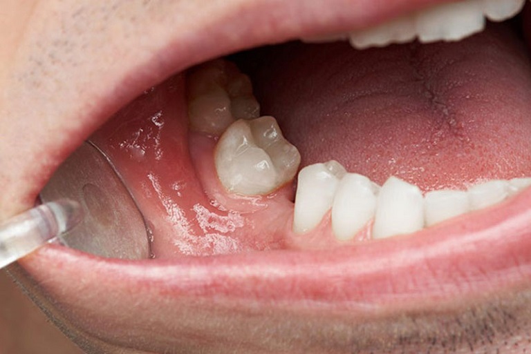 Mỗi bệnh nhân sẽ có một tình trạng răng miệng khác nhau