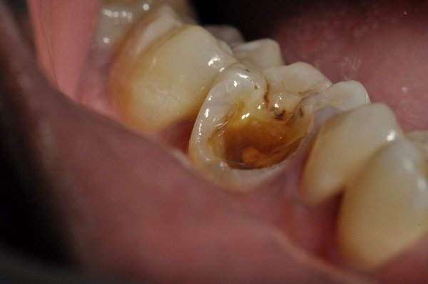 Tự điều trị răng số 7 bị sâu được không?