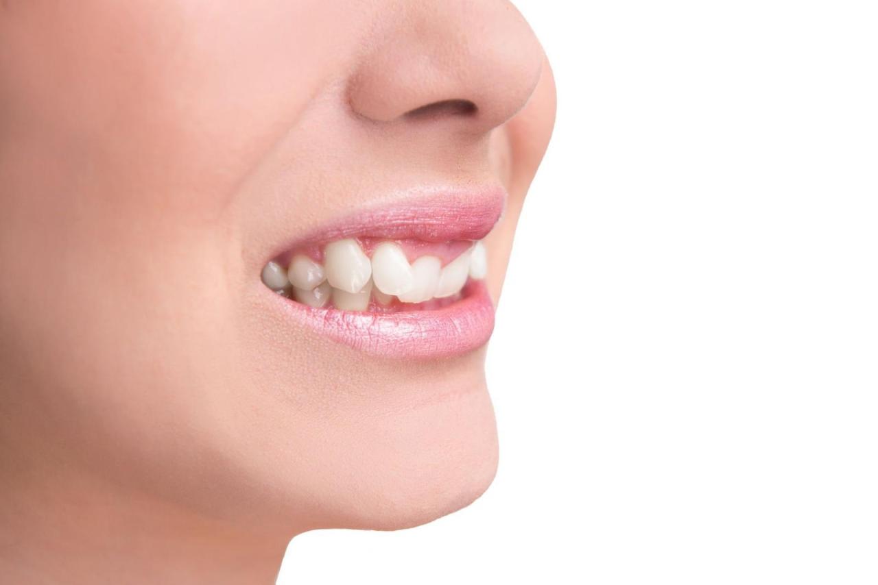 Tư vấn trồng răng khểnh hết bao nhiêu tiền mỗi chiếc | Dr. Care