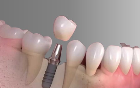 Tuổi thọ của răng implant