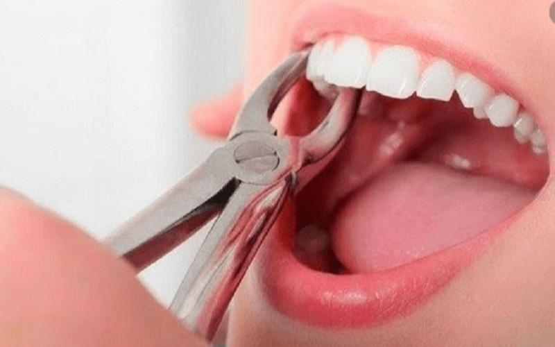 Tùy vào vị trí mọc của răng khểnh mà bác sĩ sẽ chỉ định nhổ răng hay không
