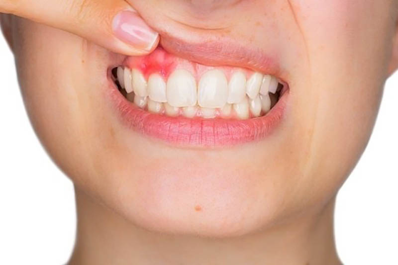 Viêm nha chu là bệnh răng miệng phổ biến