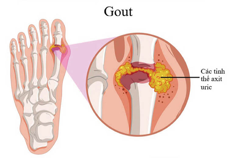 Bệnh gout (gút) là gì? Dấu hiệu, cách chẩn đoán & điều trị