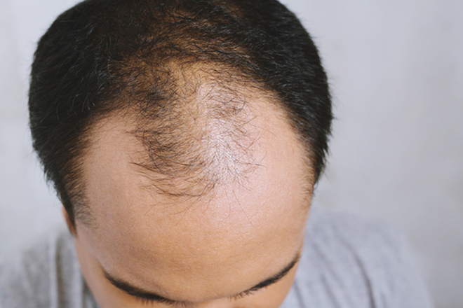 Nguy cơ hói đầu vì chứng rụng tóc nếu bạn không biết đến điều này | Báo Dân  trí