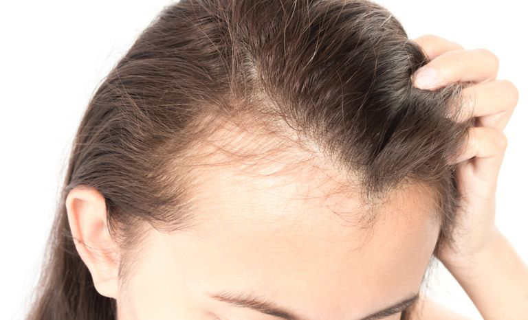 Rụng tóc bao nhiêu là bình thường? Làm thế nào để ngăn ngừa?