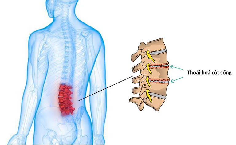 Thoái hóa cột sống thắt lưng: Nguyên nhân, triệu chứng, điều trị