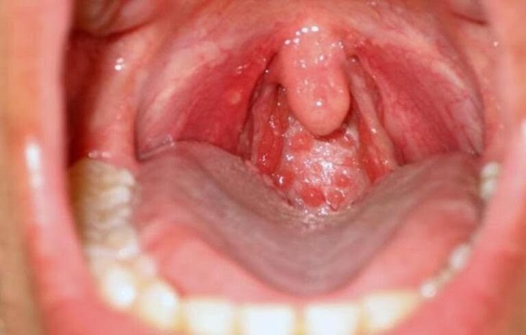 Bệnh viêm họng hạt là gì? Triệu chứng không nên bỏ qua và cách chữa DỨT ĐIỂM