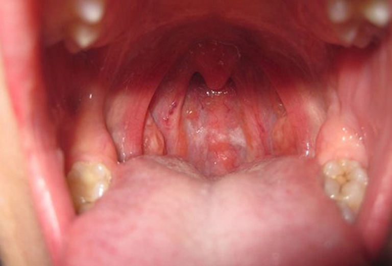 Viêm họng cấp tính là bệnh gì?