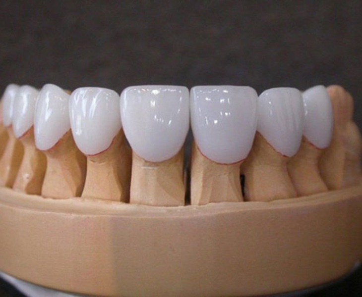 Răng sứ đảm bảo chất lượng tuyệt đối 