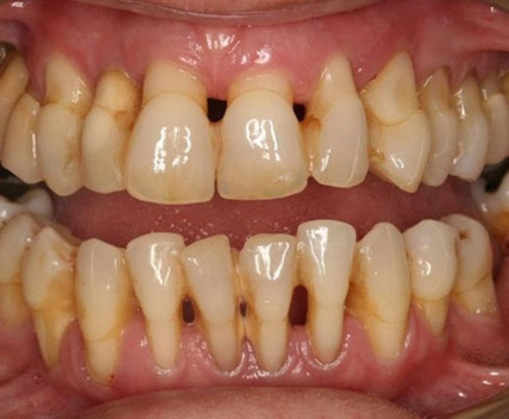 Không điều trị nha khoa trước khi bọc răng sứ gây đau nhức 