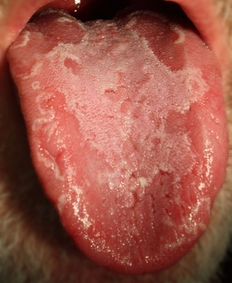 Bệnh nấm lưỡi bản đồ có nguy hiểm hay không? | VTV.VN